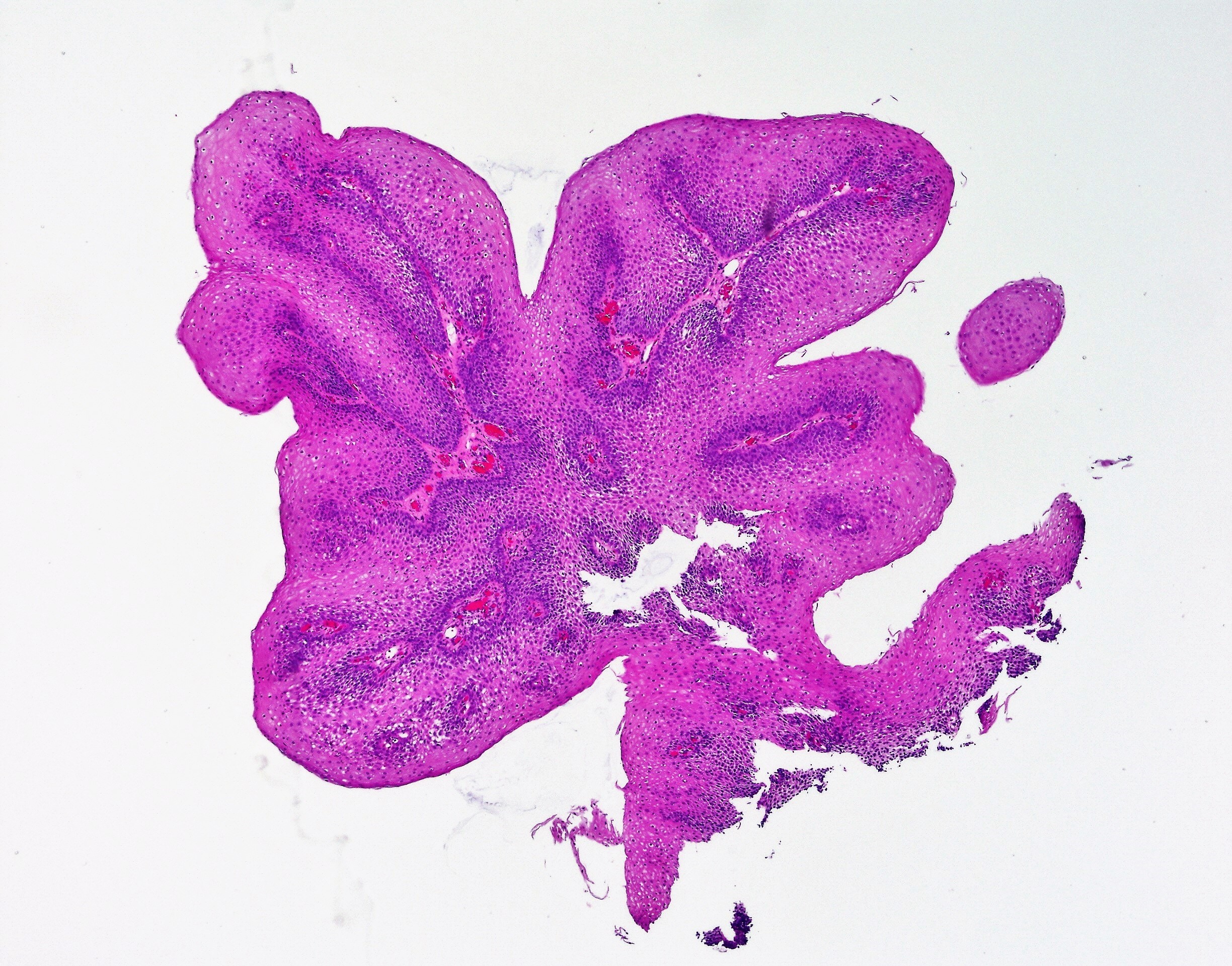 squamous papilloma icd 10 code